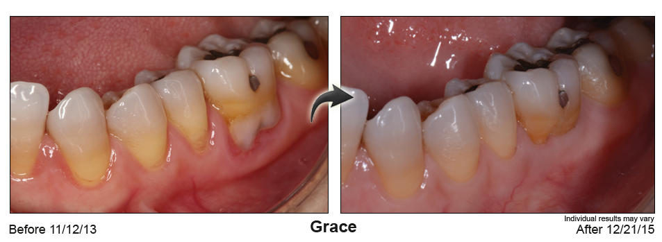 fix gum recession Elkhart IN