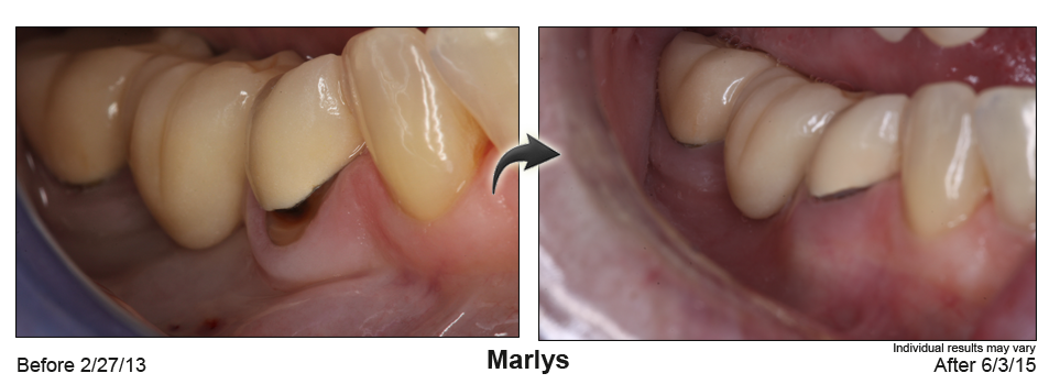 fix receding gums Elkhart IN