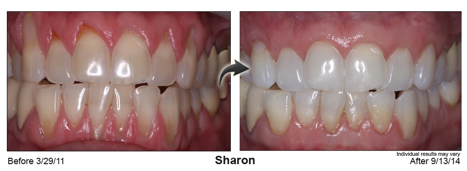 gum recession treatment Elkhart IN